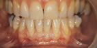 Radici dei denti scoperte
