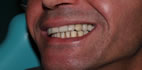 Impianti in zirconio
