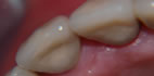 Impianti in zirconio