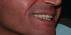 Impianti in zirconio