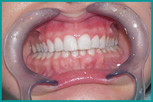 implantologia-dentale