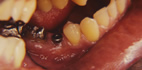 Radici dei denti scoperte